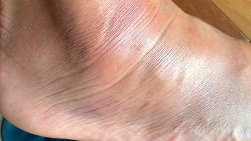 Se filtraron fotos de cómo le quedó el tobillo a Carlos Tevez